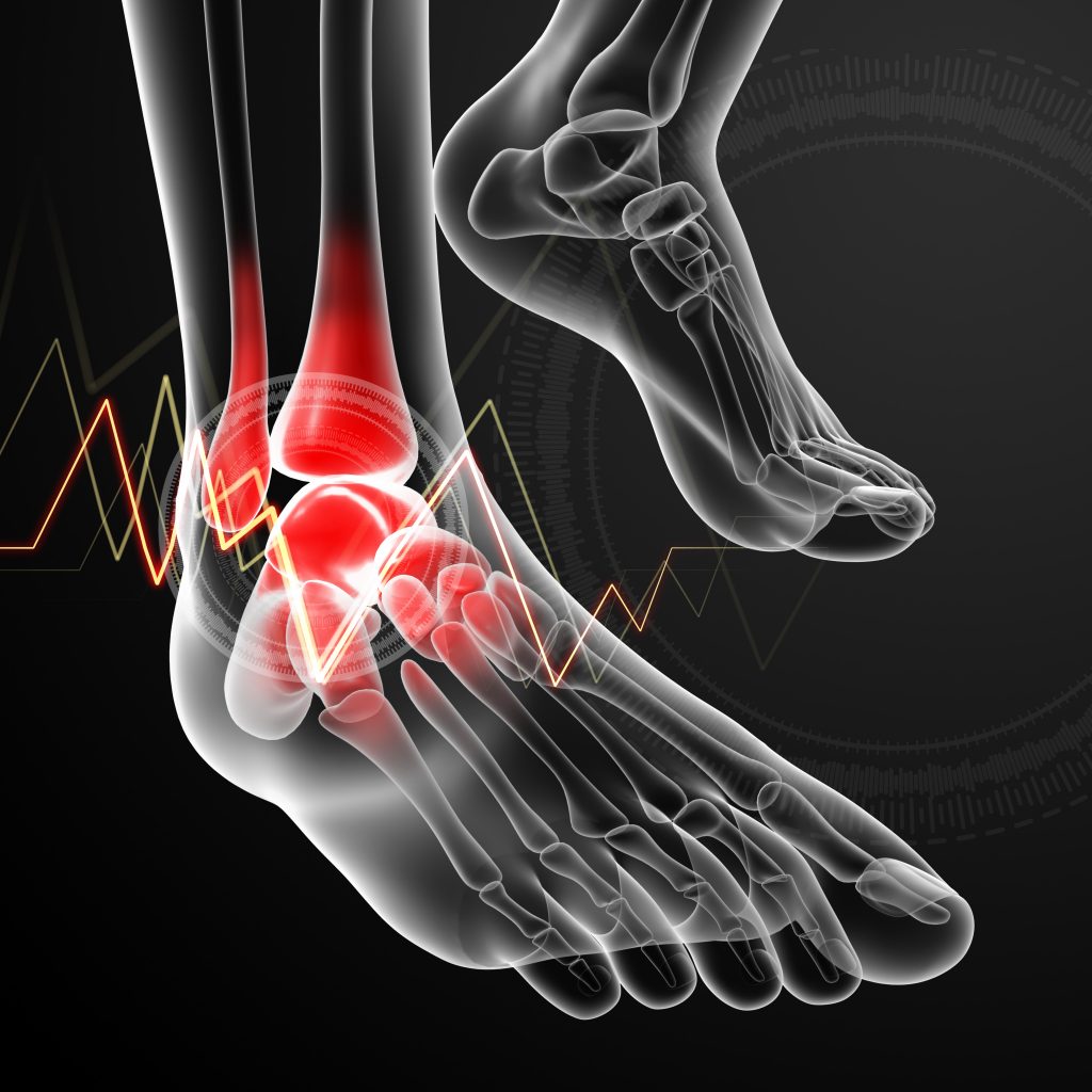 Ankle pain